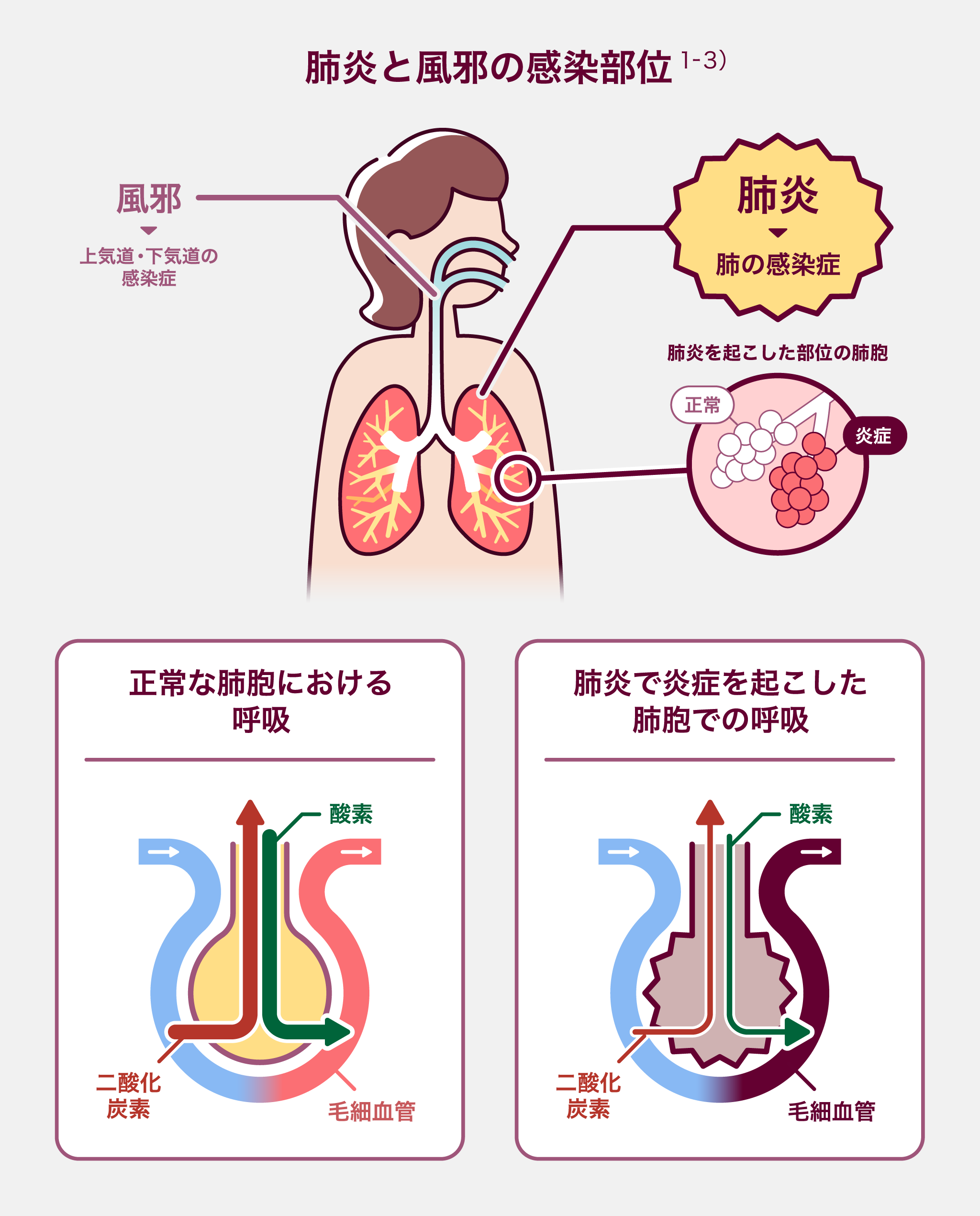 肺炎の症状 | 肺炎予防.jp